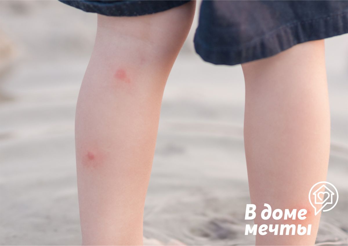 Чешется укус комара? Попробуйте эти эффективные способы, которые избавят вас от назойливого зуда! 